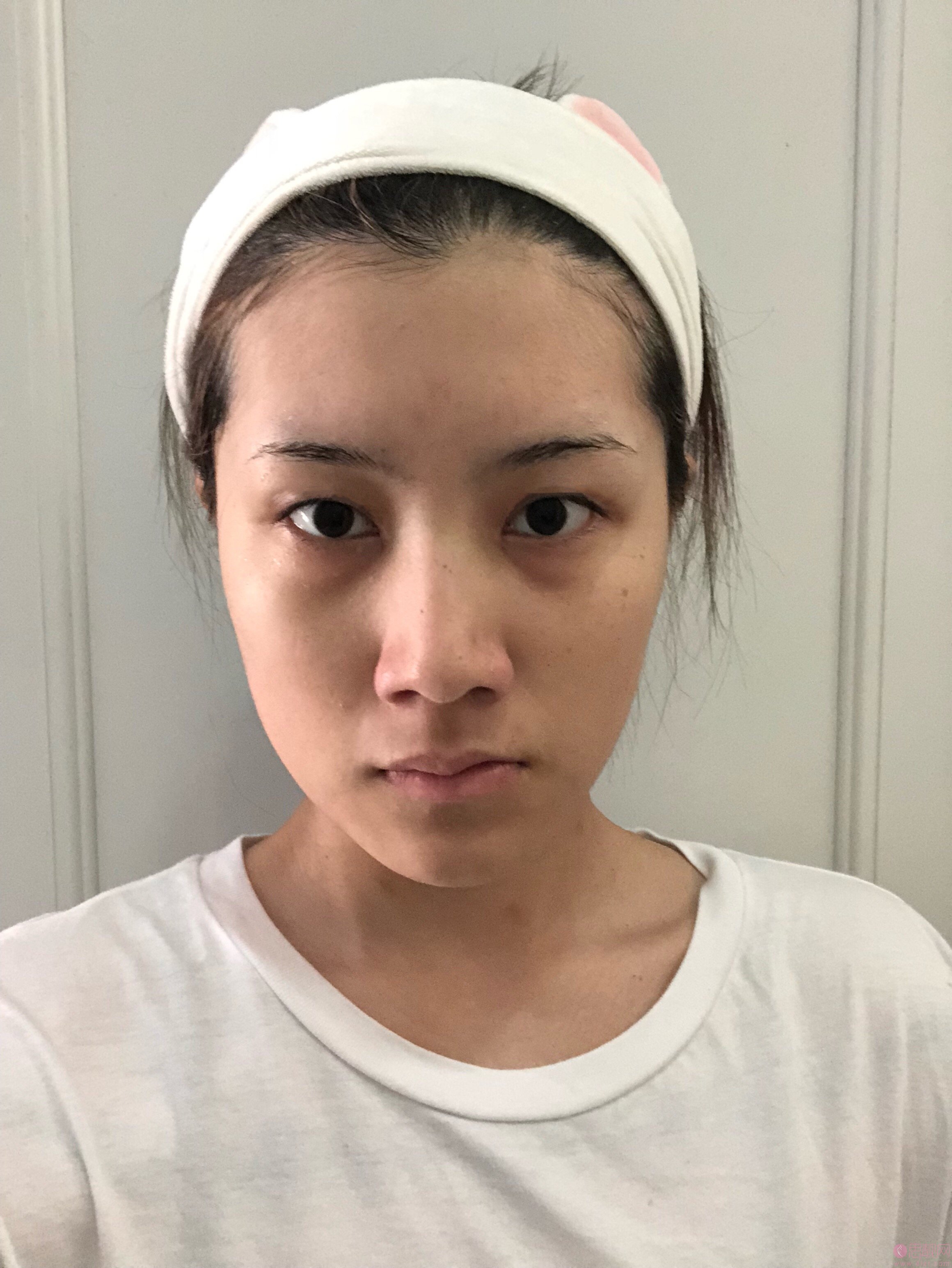 深圳鹏爱医疗美容医院价格表，附双眼皮案例