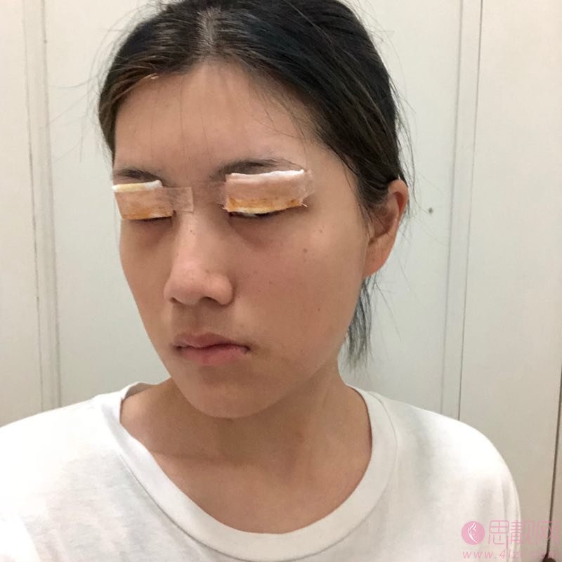 深圳鹏爱医疗美容医院价格表，附双眼皮案例