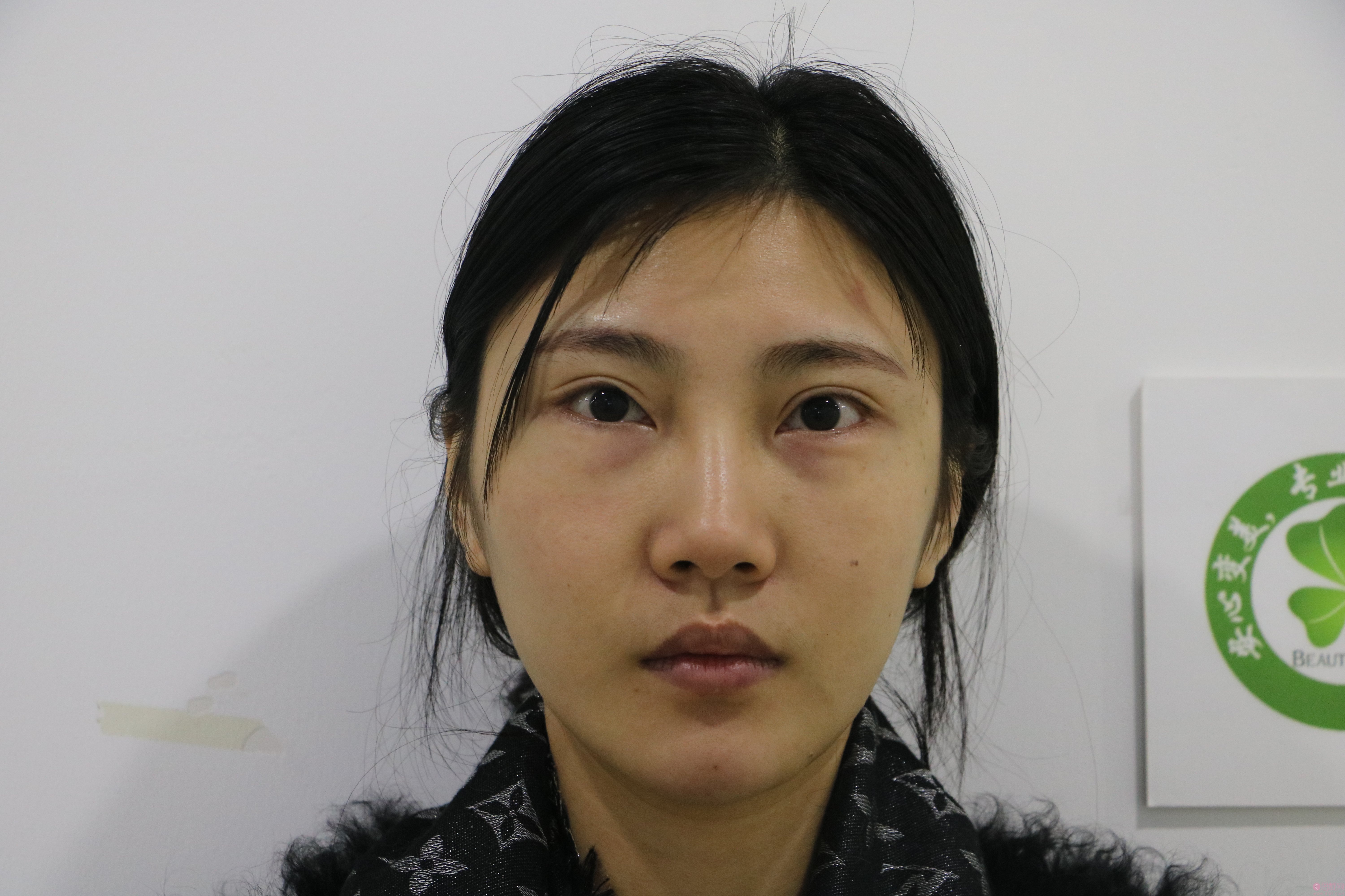 成都美未央周鹏起医生怎么样？附外眼角下至加祛眼袋案例分享