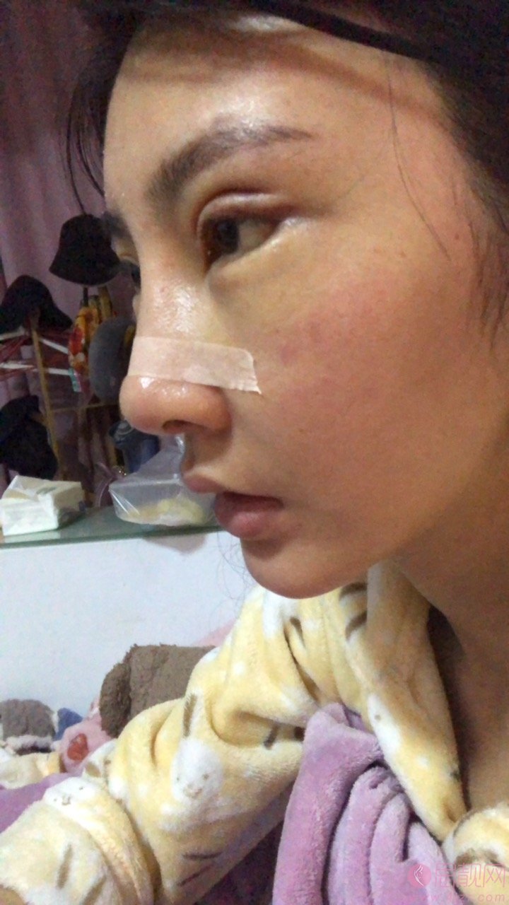 成都美未央周鹏起医生怎么样？附外眼角下至加祛眼袋案例分享