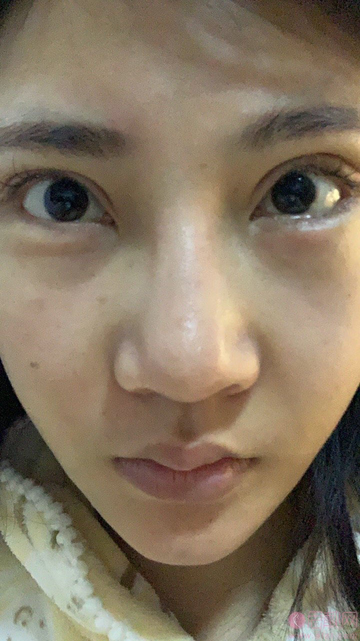 成都美未央周鹏起医生怎么样？附外眼角下至加祛眼袋案例