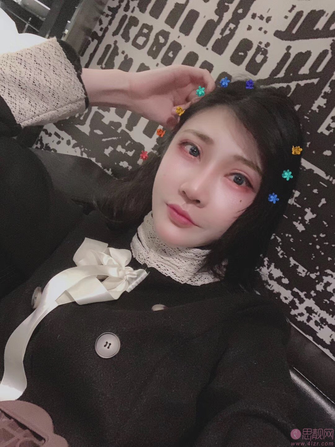成都美未央周鹏起医生怎么样？附外眼角下至加祛眼袋案例分享