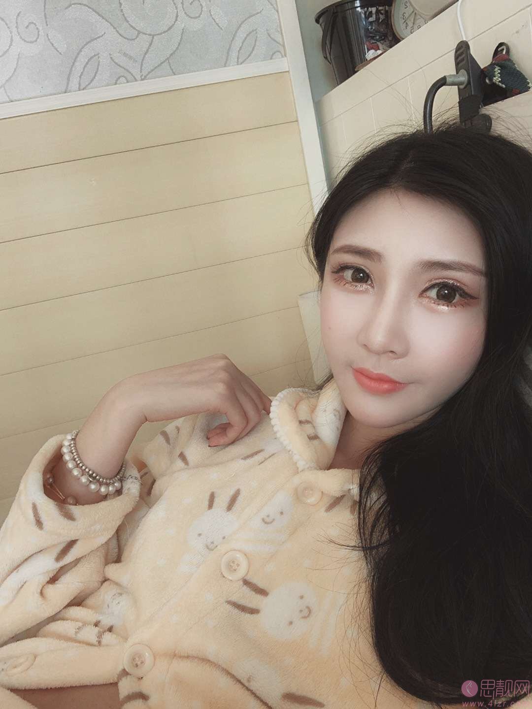 成都美未央周鹏起医生怎么样，附外眼角下至加去眼袋案例分享