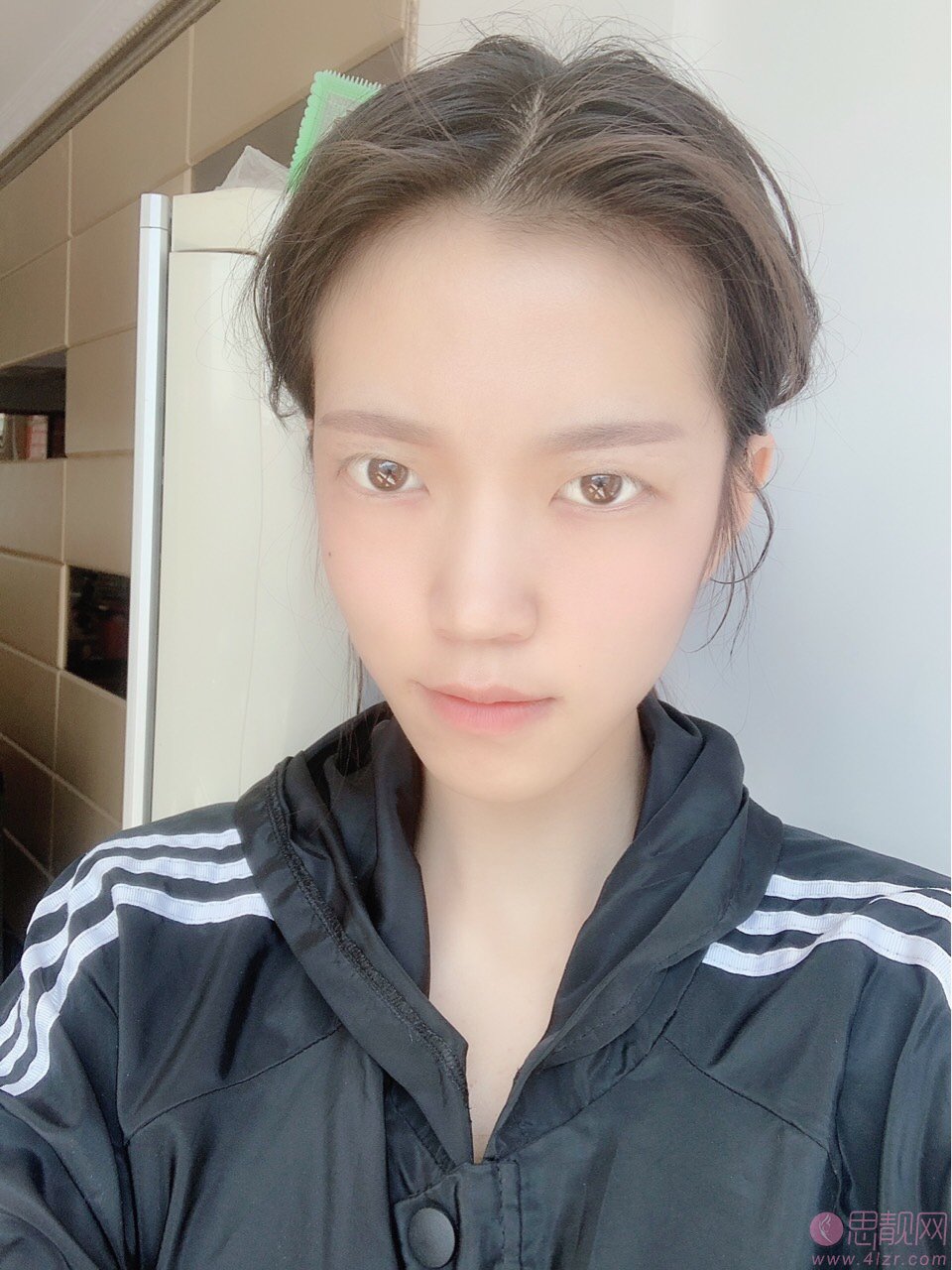 攀枝花学院附属医院整形美容科价格表，附双眼皮真人案例