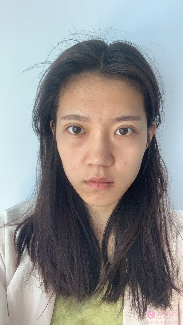 攀枝花学院附属医院整形美容科价格表，附双眼皮真人案例