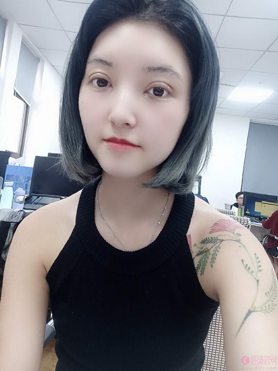 北京煤炭总医院整形科王英勇做双眼皮怎么样，附双眼皮案例