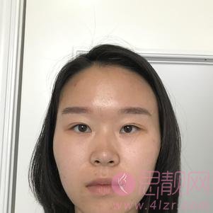 北京丽星翼美整形魏志香做双眼皮修复怎么样？附修复案例及价格表