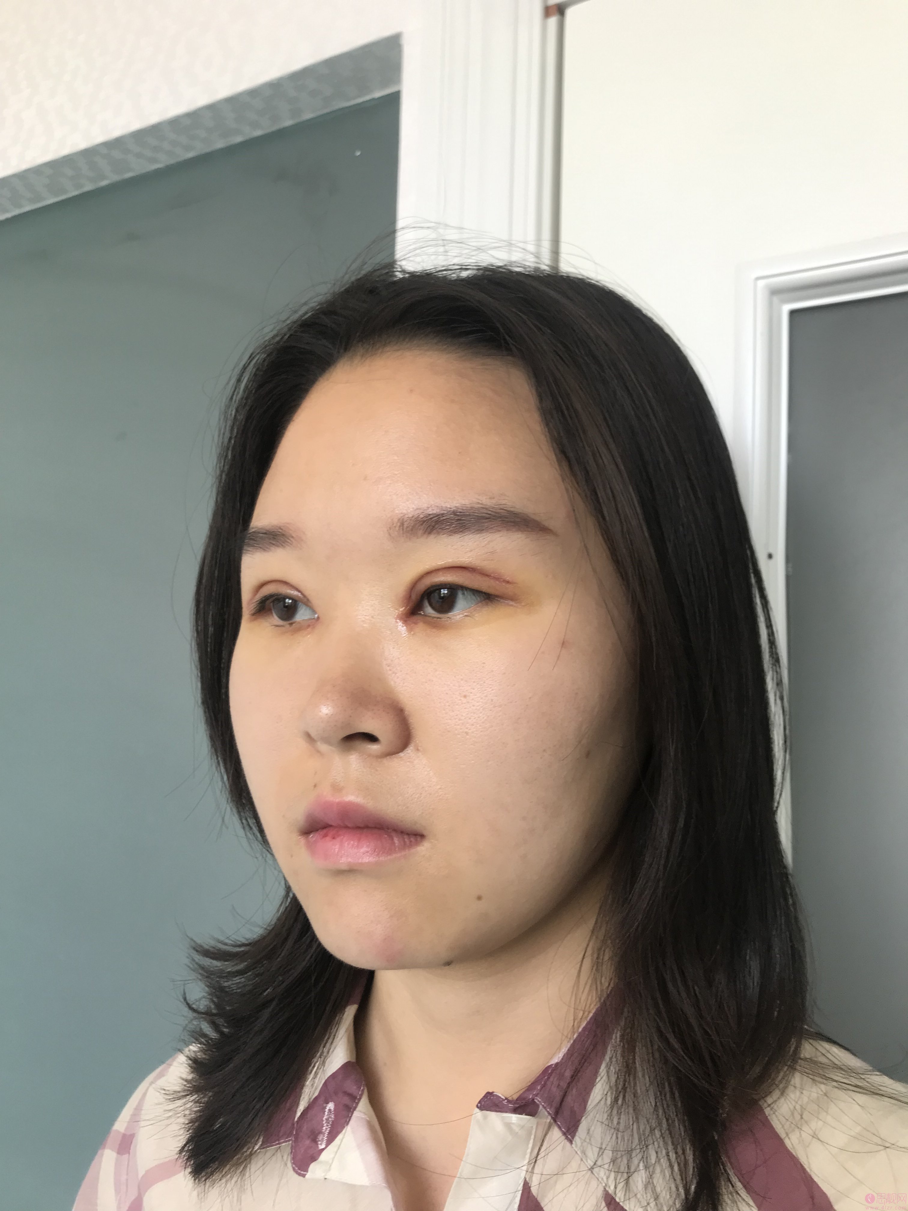 北京丽星翼美整形魏志香做双眼皮修复怎么样？附修复案例及价格表