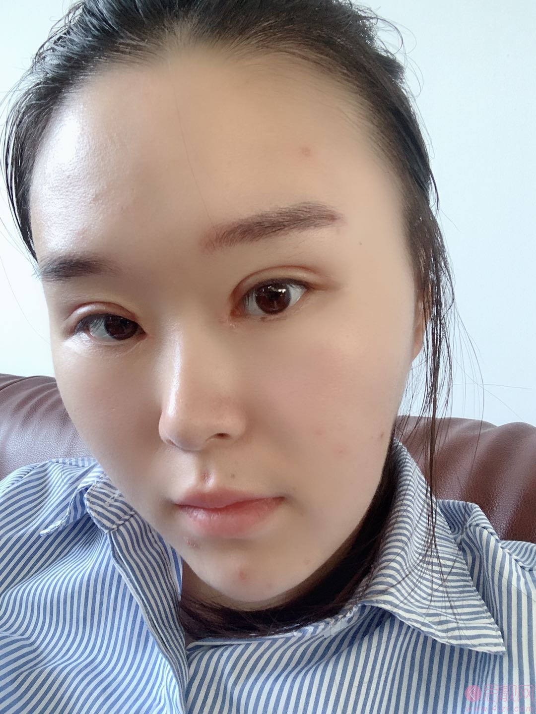 北京丽星翼美整形魏志香做双眼皮修复怎么样？附修复案例及价格表