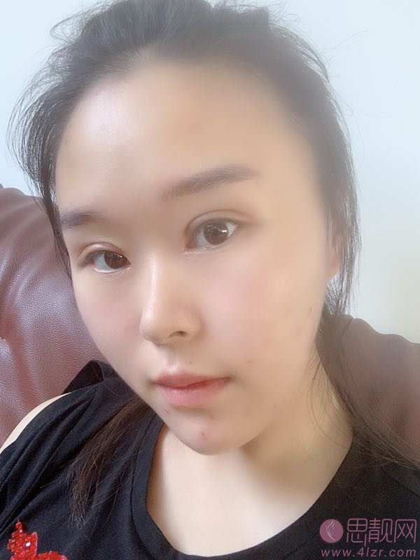 北京丽星翼美整形魏志香做双眼皮修复怎么样？附修复案例及价格表
