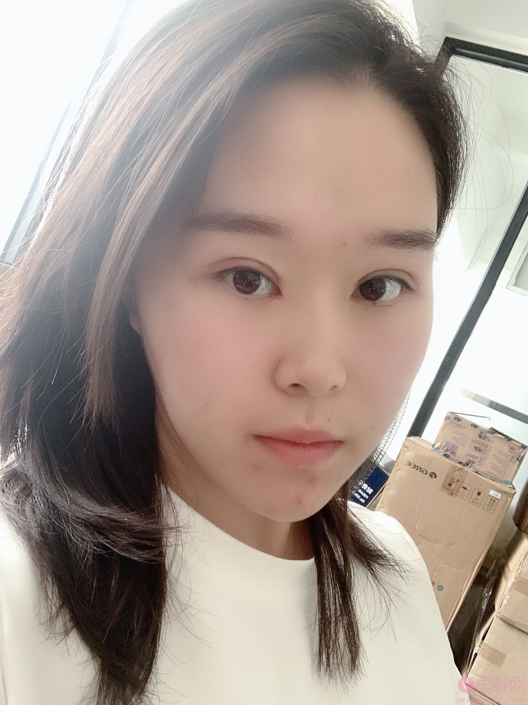 北京丽星翼美整形魏志香做双眼皮修复怎么样？附修复案例及价格表