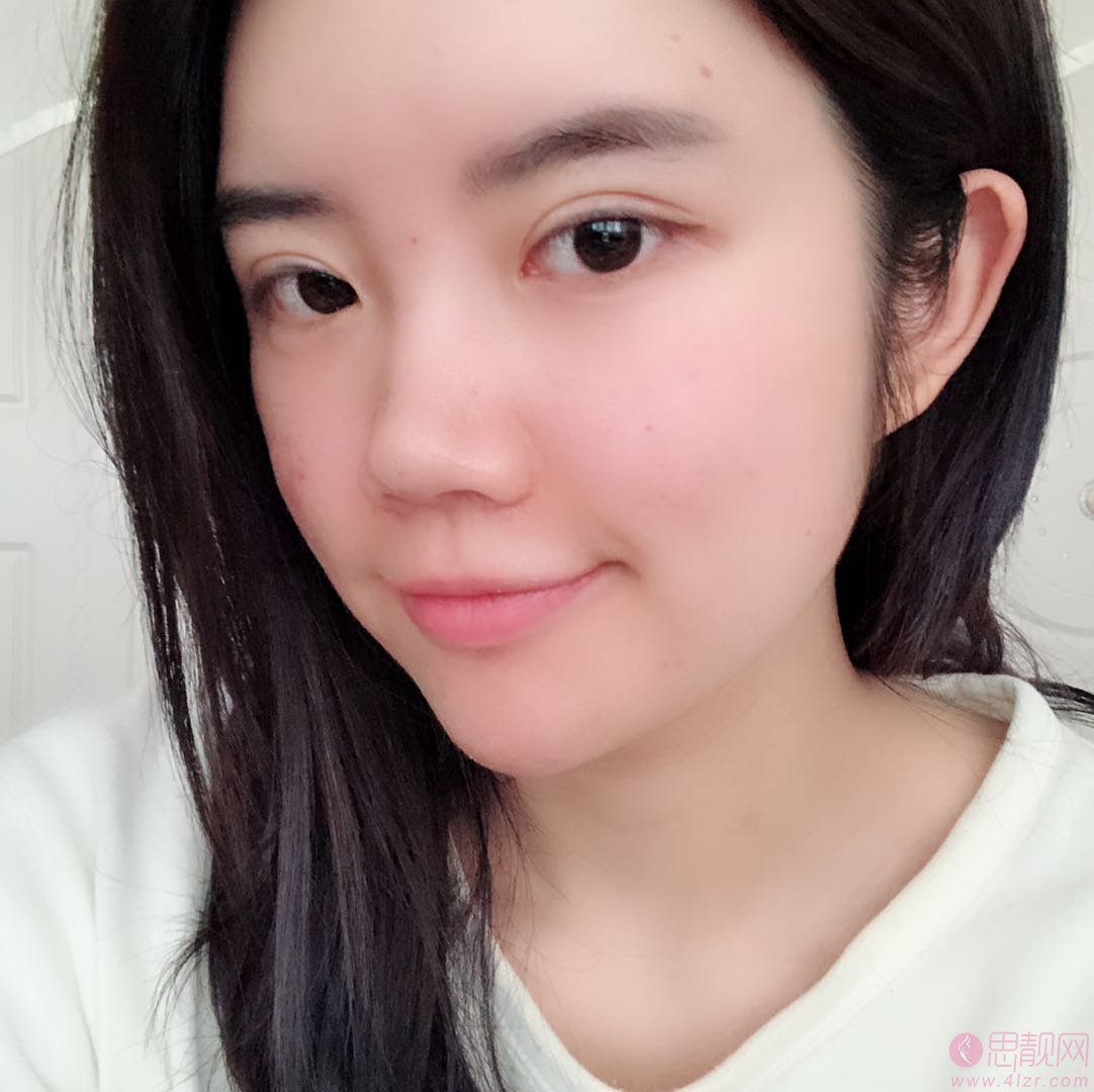 北京世熙整形医院丁砚江做鼻子怎么样，附隆鼻案例一览