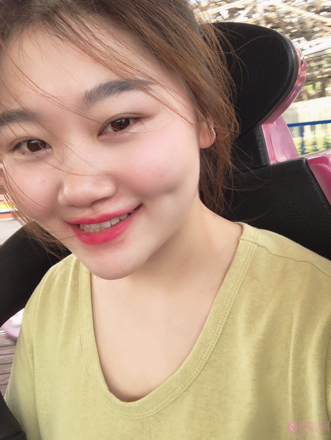 无锡苏亚医疗美容医院吕纲技术怎么样，附自体脂肪填充全脸案例及价格表