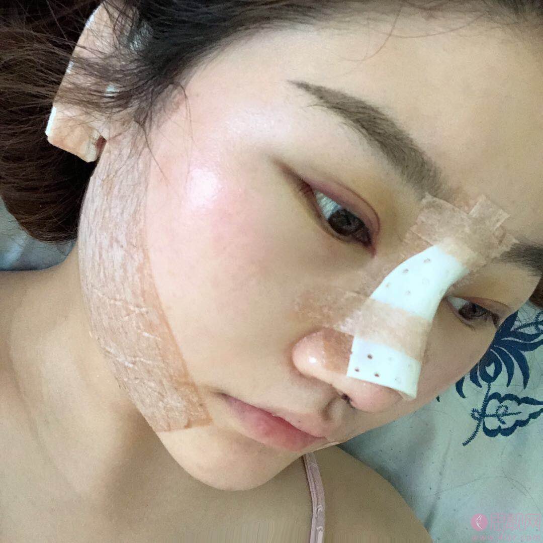 无锡苏亚医疗美容医院吕纲技术怎么样，附自体脂肪填充全脸案例及价格表
