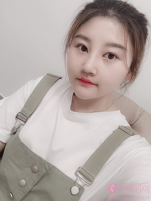 无锡苏亚医疗美容医院吕纲技术怎么样，附隆鼻案例及价格表