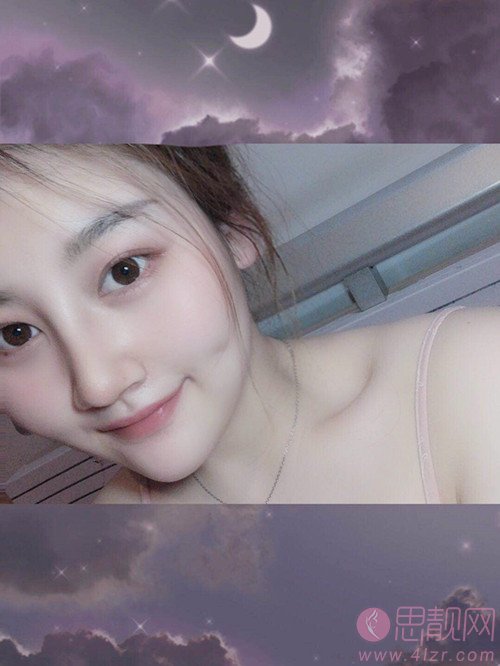 无锡苏亚医疗美容医院吕纲技术怎么样，附隆鼻案例及价格表