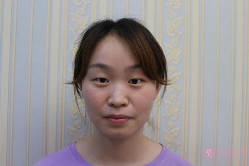 武汉美仑医疗美容陈远海个人简介，附双眼皮案例及价格表公布