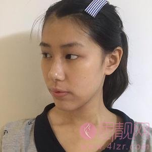台州博雅美惠医疗美容整形王大明做双眼皮怎么样？附双眼皮案例