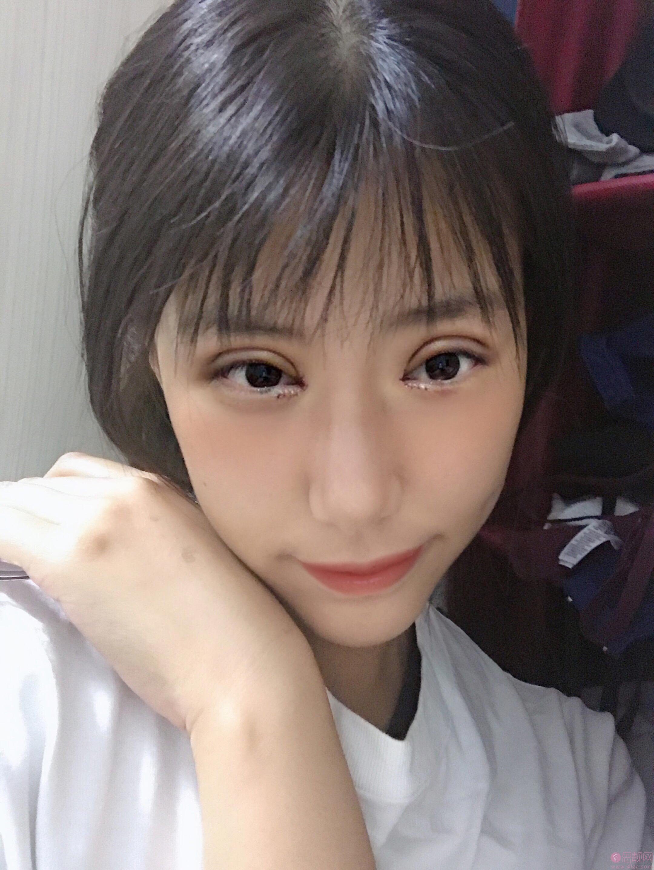 台州博雅美惠医疗美容整形王大明做双眼皮怎么样？附双眼皮案例