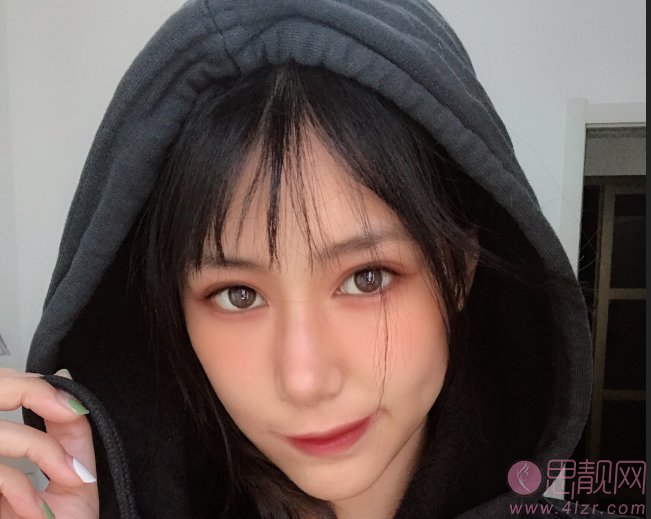 台州博雅美惠医疗美容整形王大明做双眼皮怎么样？附双眼皮案例
