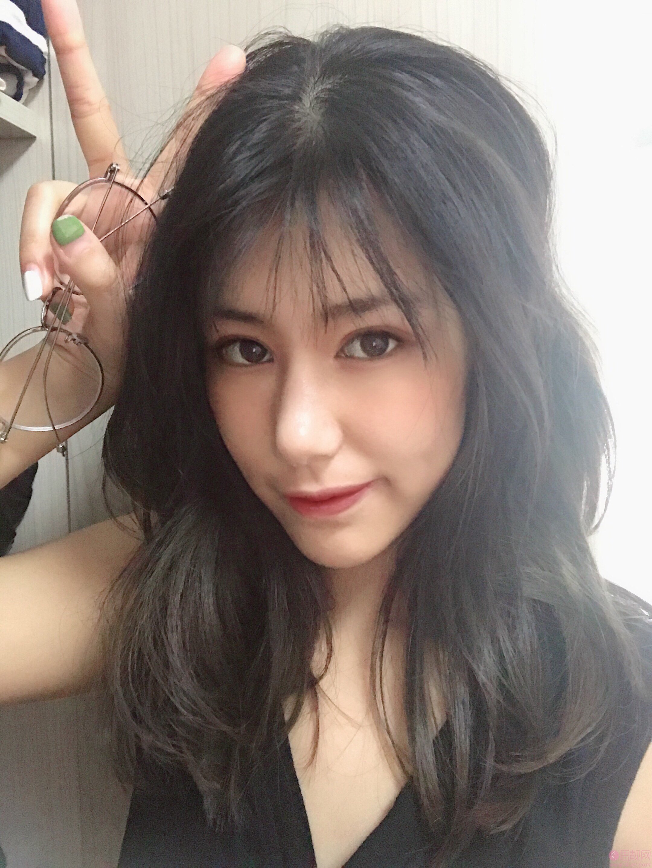 台州博雅美惠医疗美容整形王大明做双眼皮怎么样？附双眼皮案例