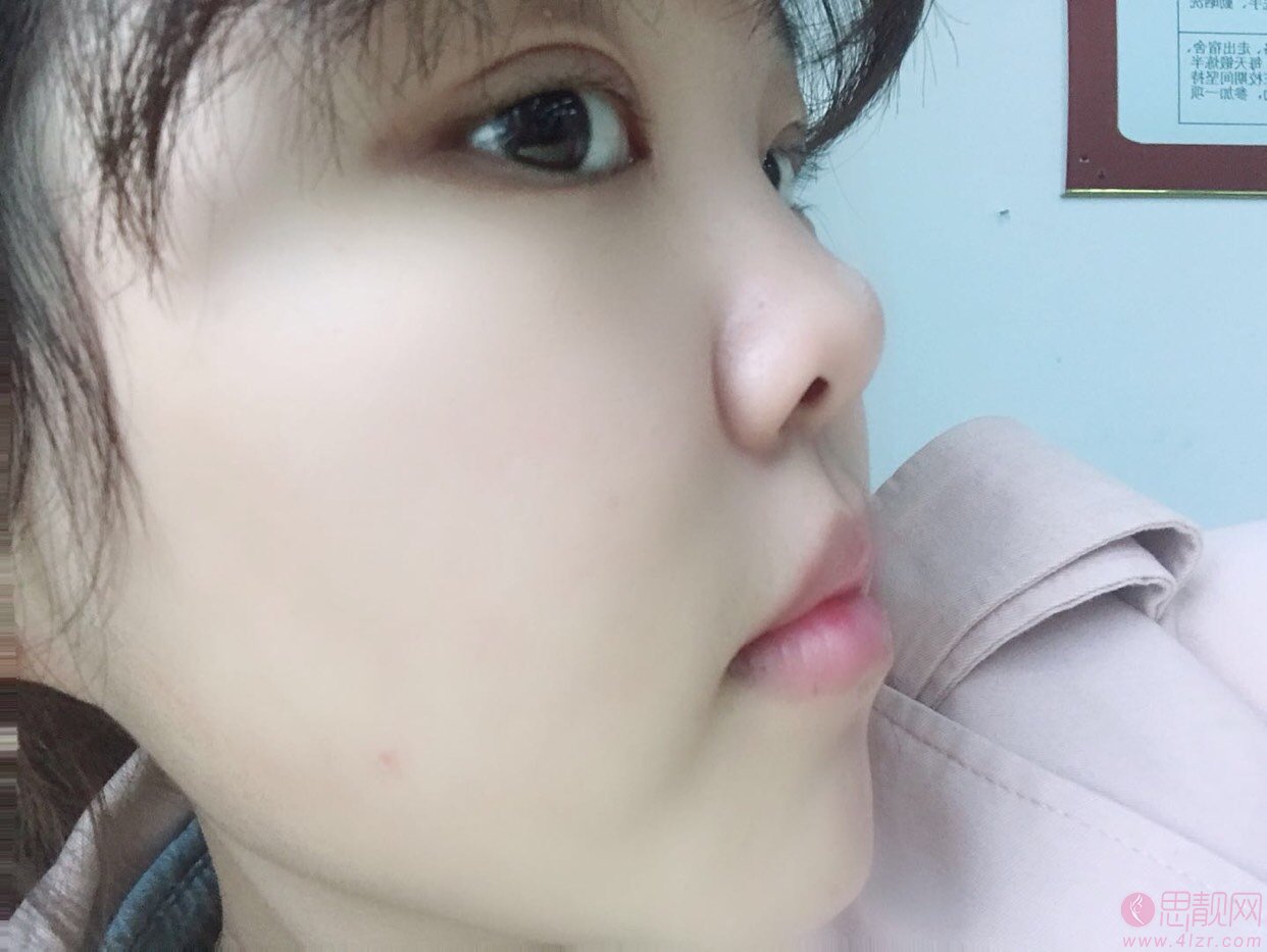 济南吉芙医疗美容解学江医生怎么样？附真人隆鼻案例