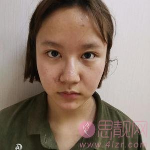 温州芘丽芙美容医院金锋医生做鼻子怎么样？附隆鼻真人案例