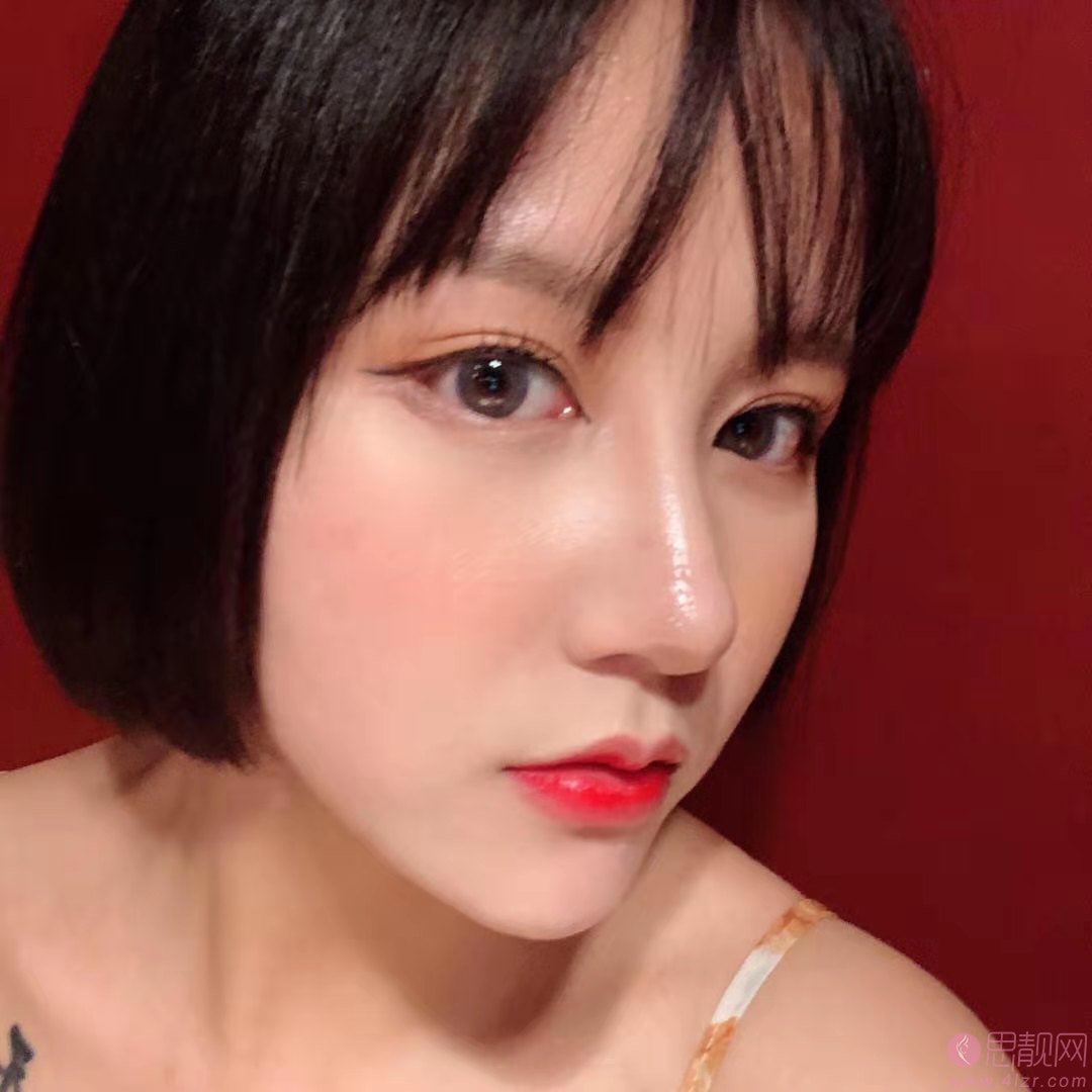 温州芘丽芙美容医院金锋医生做鼻子怎么样？附隆鼻真人案例