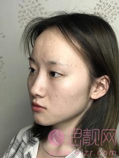 杭州薇琳医疗美容医院怎么样？附张霞飞医生双眼皮案例
