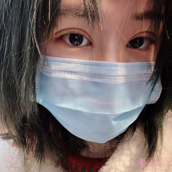 杭州薇琳医疗美容医院怎么样？附张霞飞医生双眼皮案例