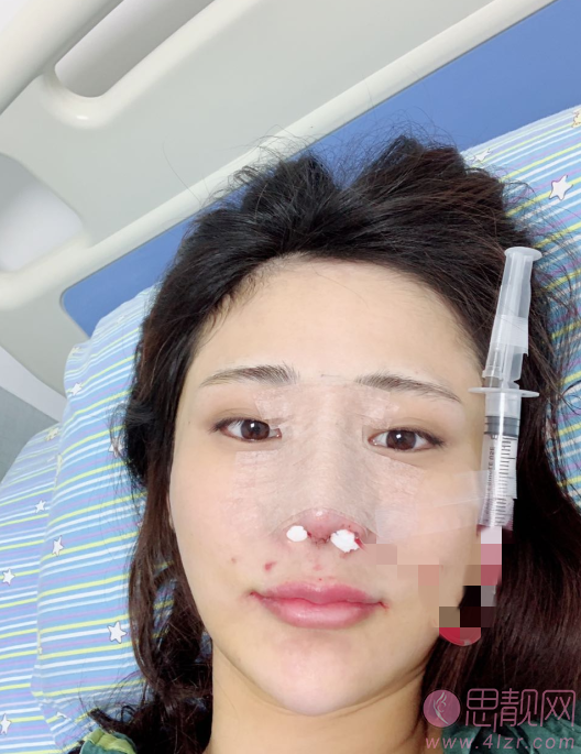 西安医学院第二附属医院医疗美容科陈杰医生做鼻子怎么样,附医生简介及隆鼻案例