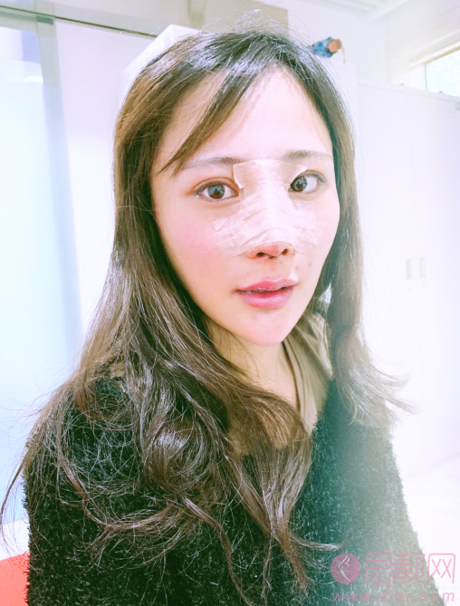 西安医学院第二附属医院医疗美容科陈杰医生做鼻子怎么样,附医生简介及隆鼻案例