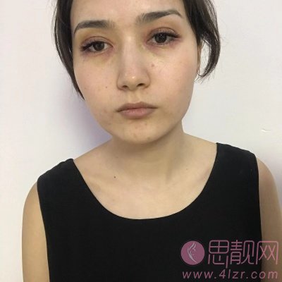 扬州施尔美整形美容医院,吴培海医生技术怎么样，附简介及双眼皮案例