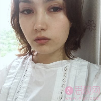 扬州施尔美整形美容医院,吴培海医生技术怎么样，附简介及双眼皮案例