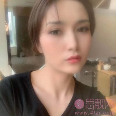 扬州施尔美整形美容医院,吴培海医生技术怎么样，附简介及双眼皮案例