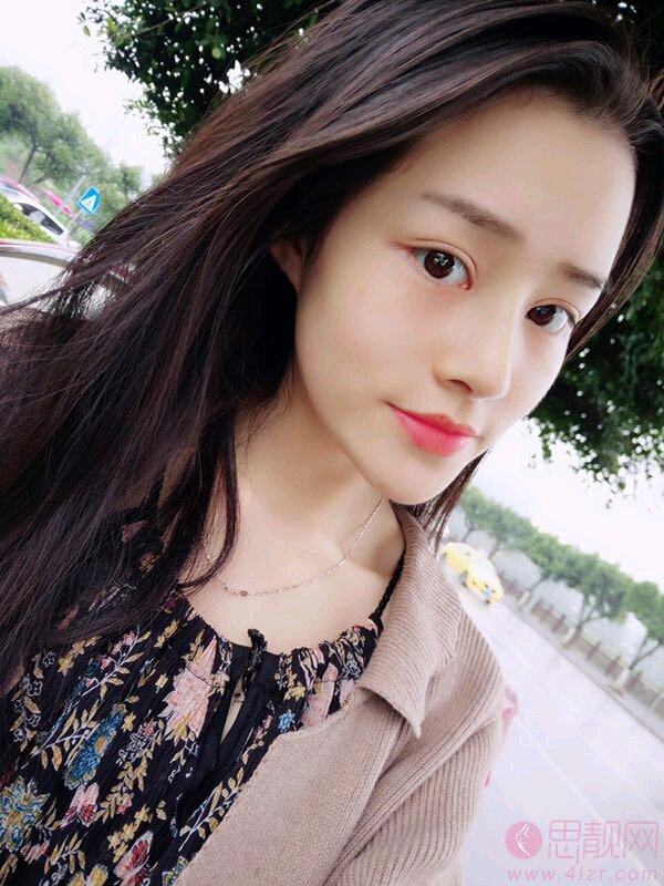 郑州天后医疗美容医院隆鼻怎么样？附隆鼻案例