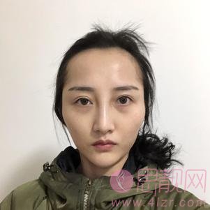 重庆星宸整形美容医院做自体脂肪填充全脸怎么样？附填充真人案例及医院价格表