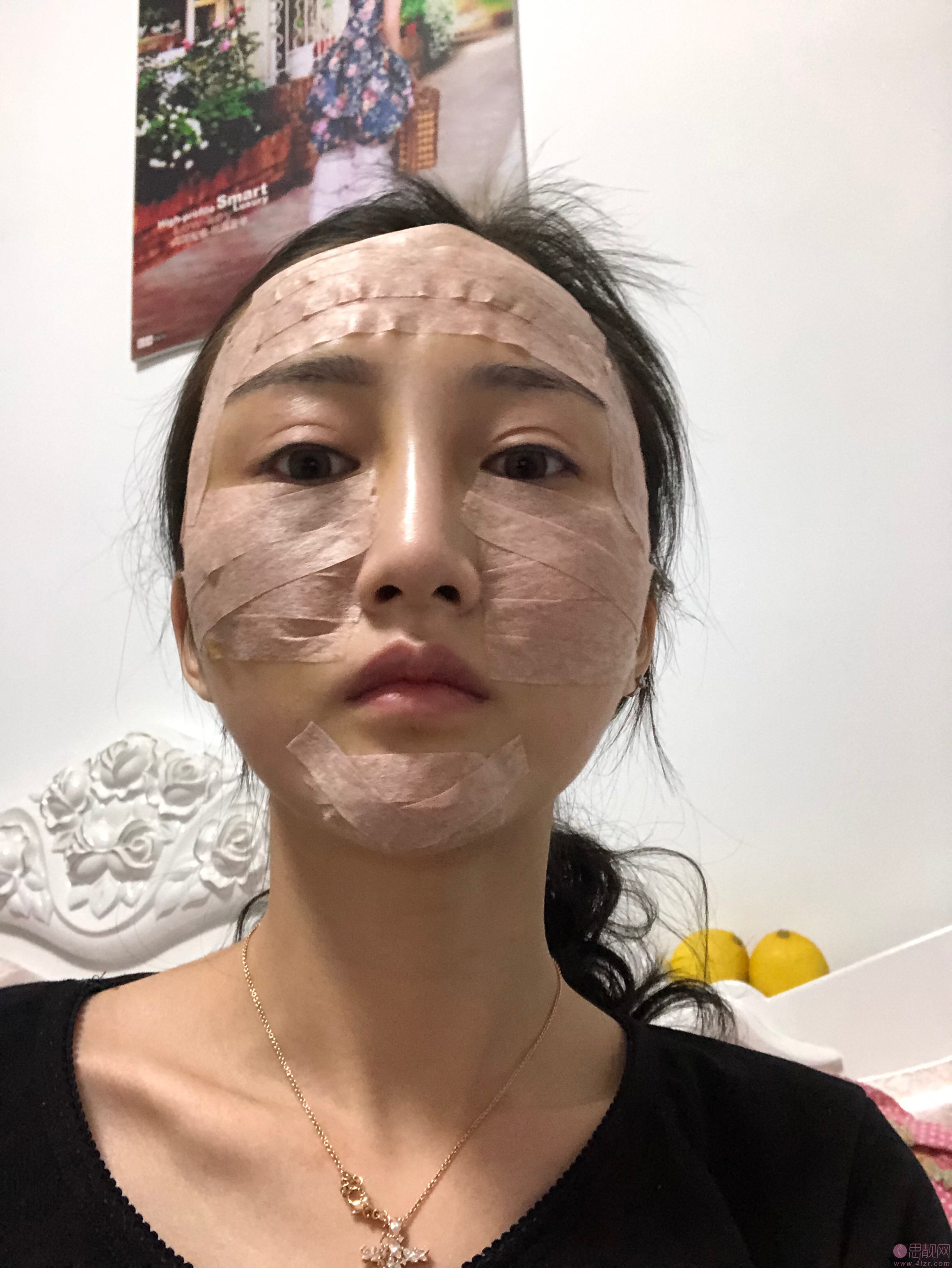 重庆星宸整形美容医院做自体脂肪填充全脸怎么样？附填充真人案例及医院价格表
