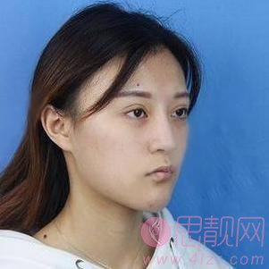 怀化华美医疗美容医院做鼻子怎么样？附隆鼻案例及医院价格表