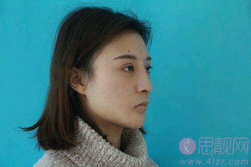 怀化华美医疗美容医院做鼻子怎么样？附隆鼻案例及医院价格表