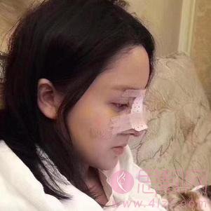 厦门安黛美医疗整形美容林清福做隆鼻怎么样？附隆鼻真人案例