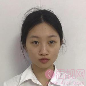 长沙华韩华美医疗美容医院做鼻子怎么样？附鼻部整形案例及价格表