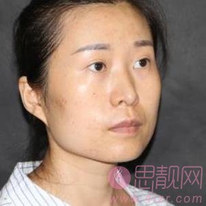 烟台华怡整形医院做双眼皮怎么样？附双眼皮前后案例对比