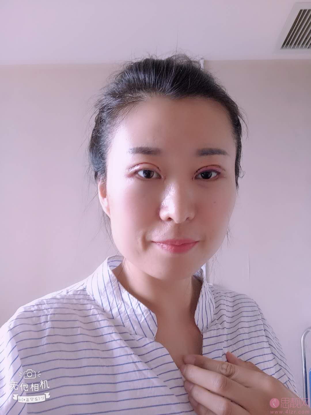 烟台华怡整形医院做双眼皮怎么样？附双眼皮前后案例对比