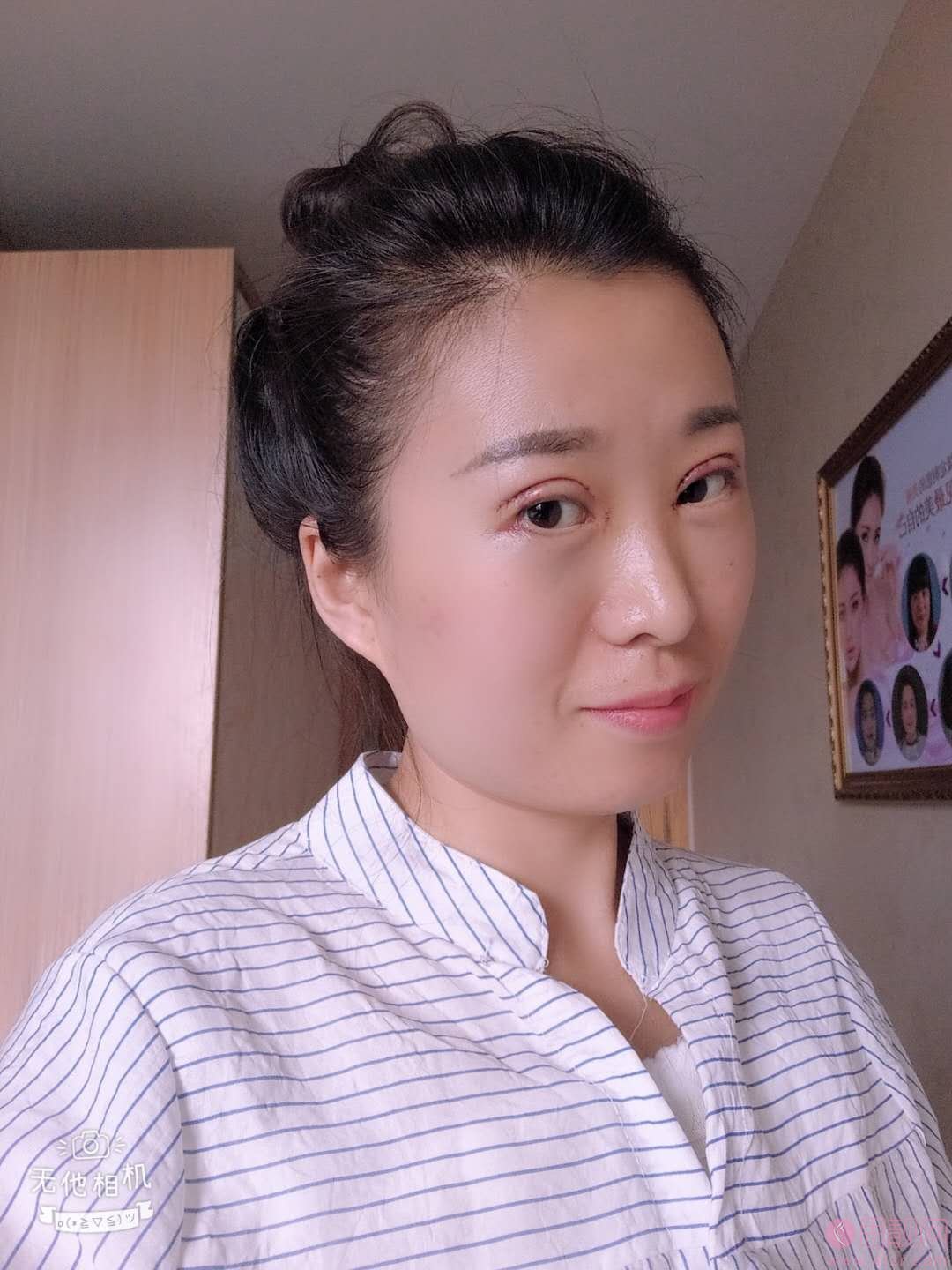 烟台华怡整形医院做双眼皮怎么样？附双眼皮前后案例对比
