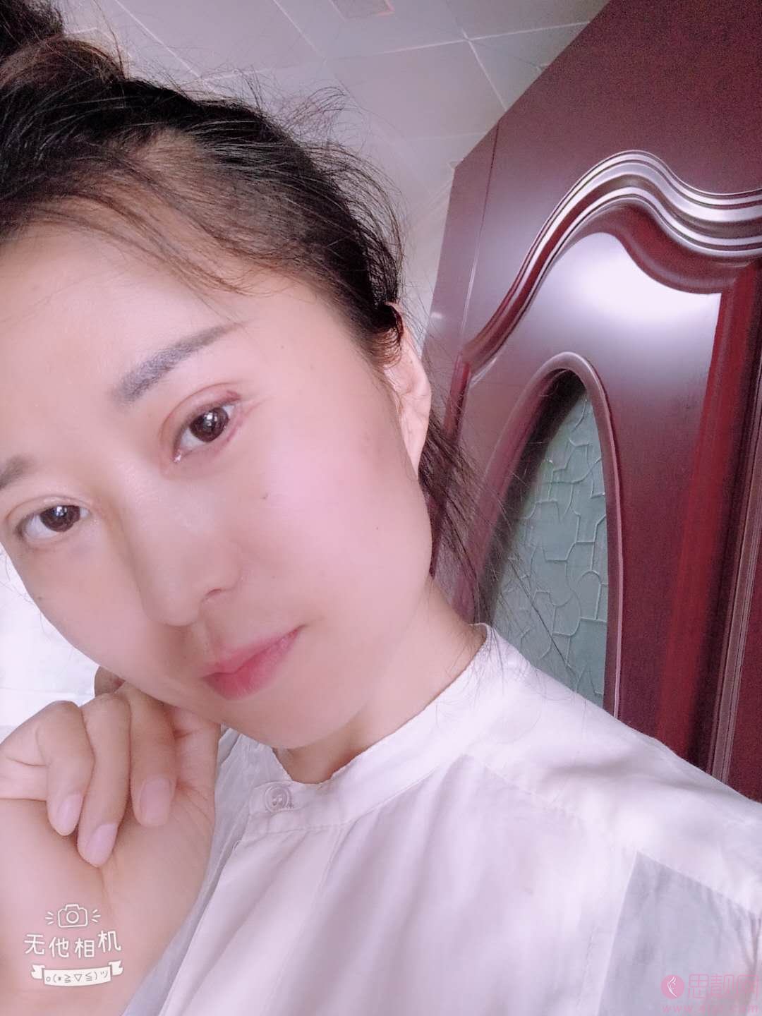 烟台华怡整形医院做双眼皮怎么样？附双眼皮前后案例对比