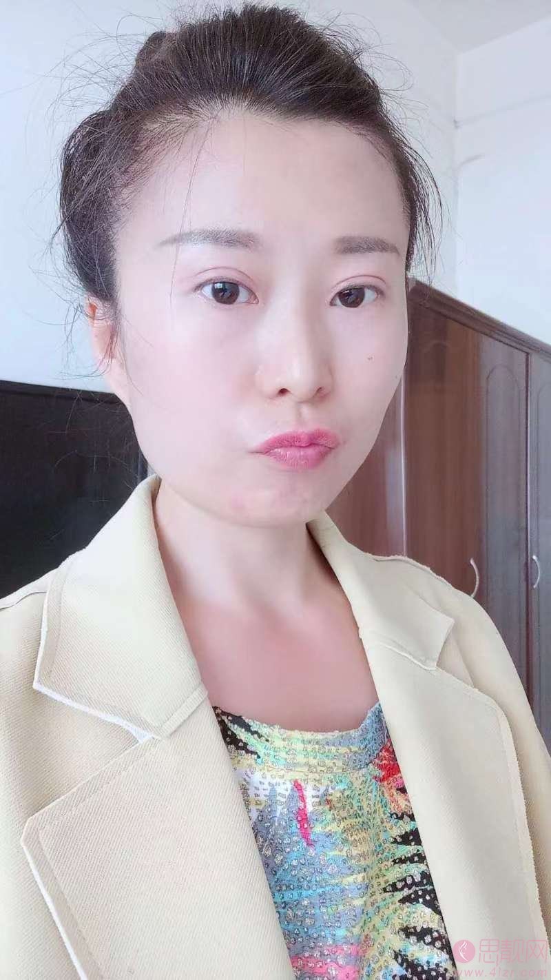 烟台华怡整形医院做双眼皮怎么样？附双眼皮前后案例对比