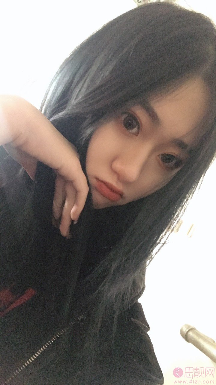 南昌莱美美容医院价格表，附余攀隆鼻案例一览
