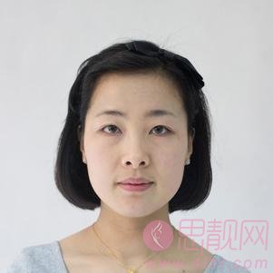 沈阳百嘉丽医疗美容医院价格表，及全切双眼皮效果一览