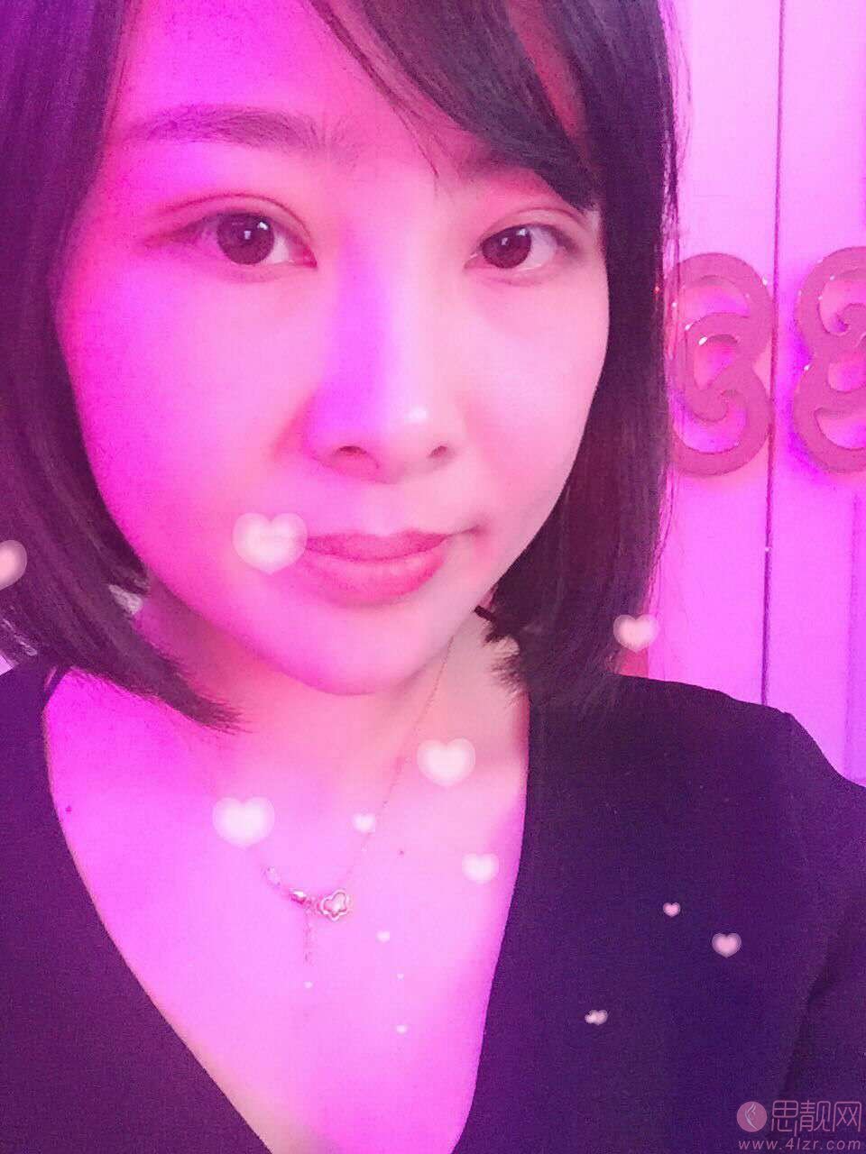沈阳百嘉丽医疗美容医院价格表，及全切双眼皮效果一览